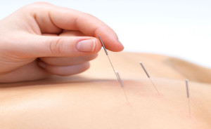 séance d'acupuncture